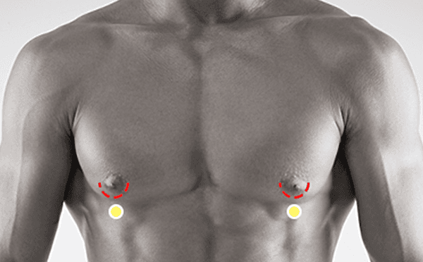 Gynecomastia surgery