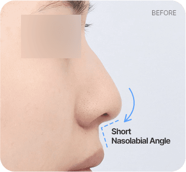 CASE 1. Short Nasolabial Angle before