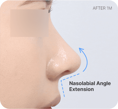 CASE 1. Short Nasolabial Angle after