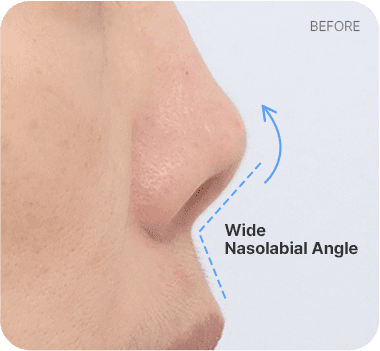 CASE 2. Wide Nasolabial Angle before