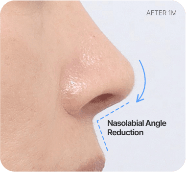 CASE 2. Wide Nasolabial Angle after