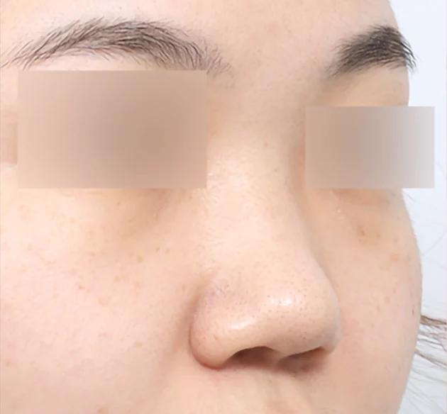 Natural nose bridge before