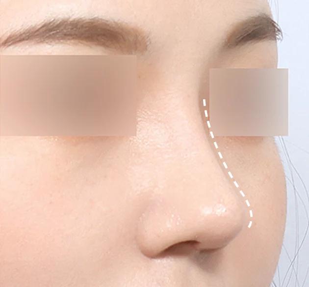 Natural nose bridge after