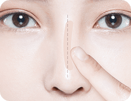 revision-rhinoplasty