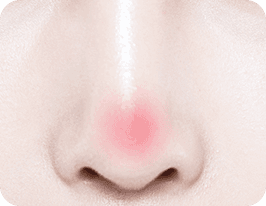 revision-rhinoplasty