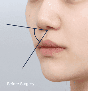 Side profile with a sunken philtrum and hollow appearance