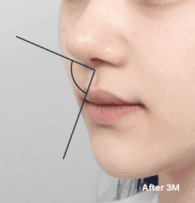 Harmonious side profile with balanced angles of the columella and philtrum