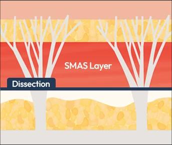 Deep plane facelift: skin and SMAS layer lifted together