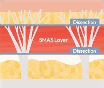Dual plane facelift: skin and SMAS layers separately dissected and lifted
