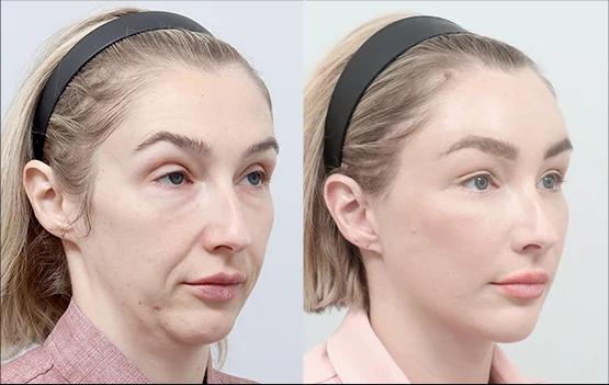 Stage 3 Full Face Lifting before and after