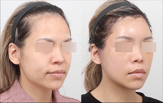 Stage 2 Semi Face Lifting before and after