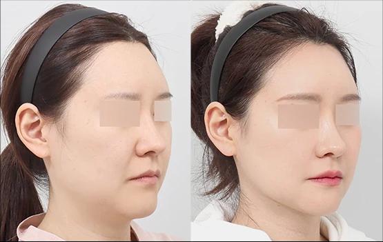 Stage 1 Mini Face Lifting before and after