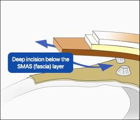 Deep incision below the SMAS (fascia) layer