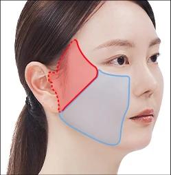 Midface Semi Face Lifting