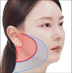 Lower Face Semi Face Lifting