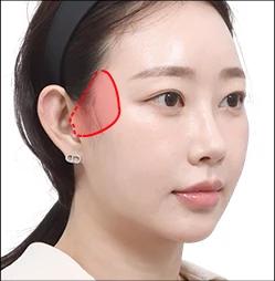 Mini Face Lifting