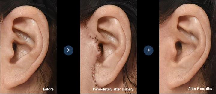 Healing process of the incision: before, immediately after surgery, after 6 months