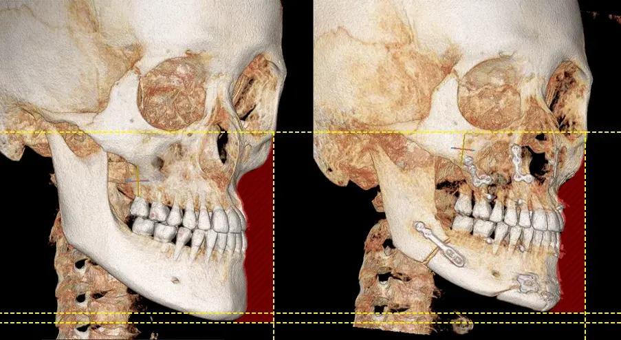Orthognathic surgery 3D-CT before and after