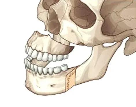 STEP 2. Maxillary and Mandibular Osteotomy