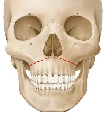 Maxillary Surgery Method