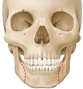 Mandibular Surgery Method