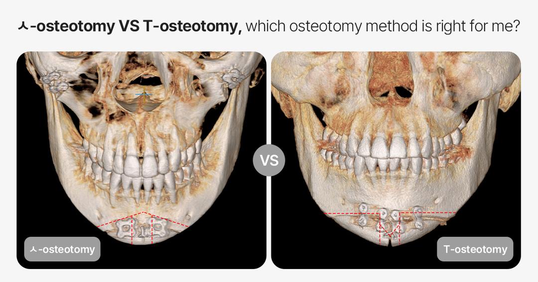 Chin Surgery: T Osteotomy vs. ㅅOsteotomy (Inverted-V-shaped osteotomy) Which Osteotomy Method Is Right for You?