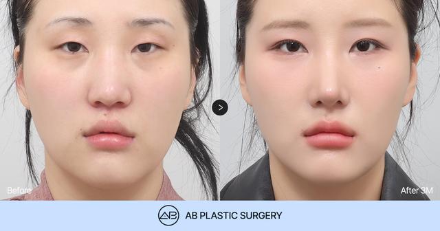 Can Rhinoplasty Reduce Midface Length? Long Nose Rhinoplasty Review thumbnail
