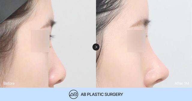 How to Choose the Right Hospital for Revision Rhinoplasty thumbnail