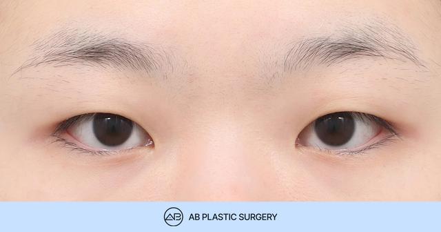 Key Considerations for Double Eyelid Surgery in Patients with Monolids thumbnail