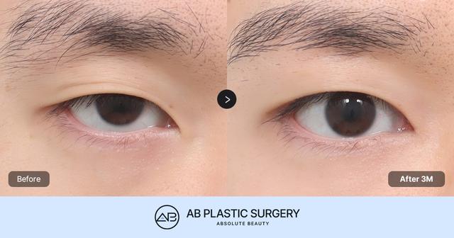 The Key to Masculine Eye Surgery: Creating Naturally Long and Defined Eyes thumbnail