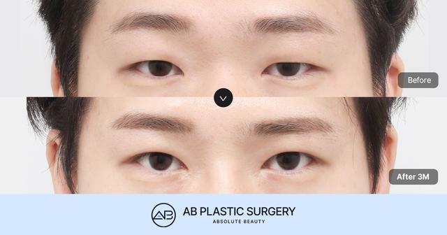 Natural Male Eye Correction Surgery Methods Seen Through Male Ptosis Correction Reviews thumbnail