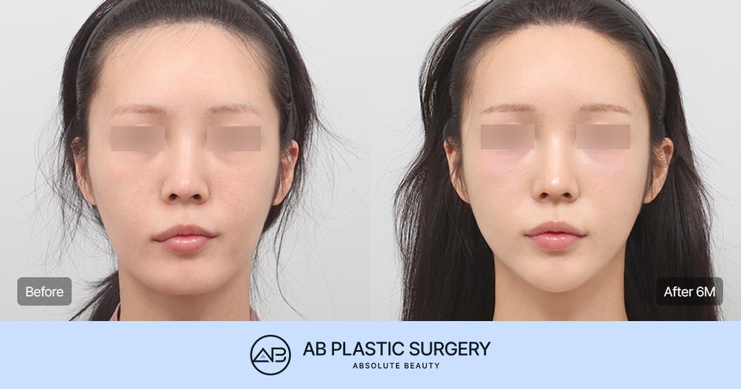 Can You Achieve a Smaller, More Refined Face Like a Celebrity Without the Side Effects of Facial Contouring Surgery?