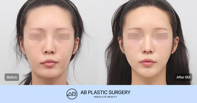 Can You Achieve a Smaller, More Refined Face Like a Celebrity Without the Side Effects of Facial Contouring Surgery? thumbnail