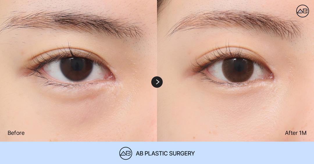 Avoid Regret After Under Eye Fat Removal: The Difference Between Under Eye Fat Removal and Repositioning You Should Check Before Surgery