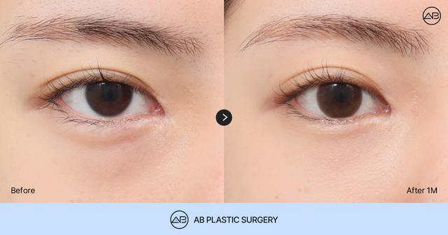 Avoid Regret After Under Eye Fat Removal: The Difference Between Under Eye Fat Removal and Repositioning You Should Check Before Surgery thumbnail