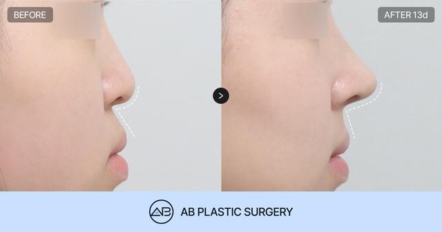 Why Columella and Nasolabial Angle Correction Matter for Achieving a Refined Rhinoplasty Result thumbnail