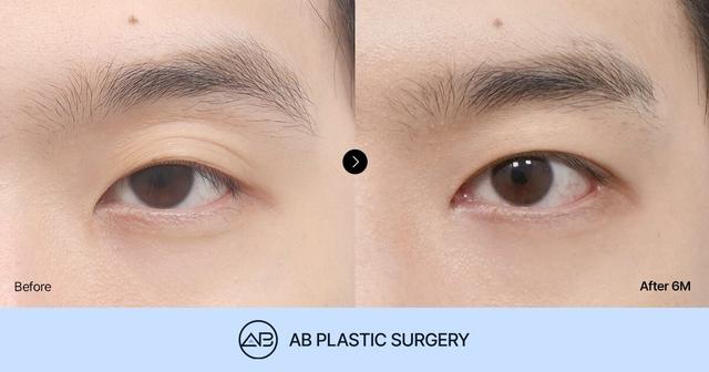 Tired and Droopy Looking Male Eyes Improved into a Refreshed Look: Before and After Male Eyelid Surgery thumbnail