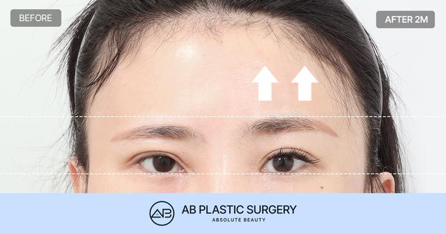 Endoscopic Forehead Lift: Bone Tunneling vs Endotine Fixation, A Comparison of Methods and Results thumbnail