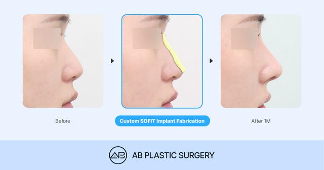 SOFIT Rhinoplasty: How Is It Different from Conventional Rhinoplasty? When Is a Customized Implant Needed? thumbnail