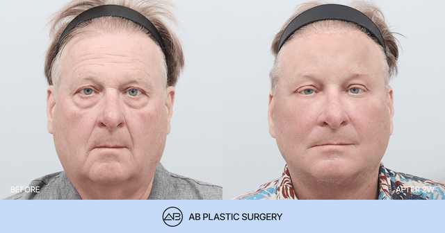 Before and After Facelift Surgery in Korea: Improving Sagging Skin and Restoring a Defined Jawline thumbnail