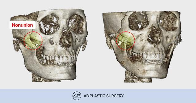 Did the Bone Separate After Zygoma Reduction Surgery? Misconceptions and the Real Causes of Zygomatic Nonunion thumbnail