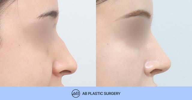Why Is the Nasal Shape Still Unsatisfactory After Revision Rhinoplasty? thumbnail