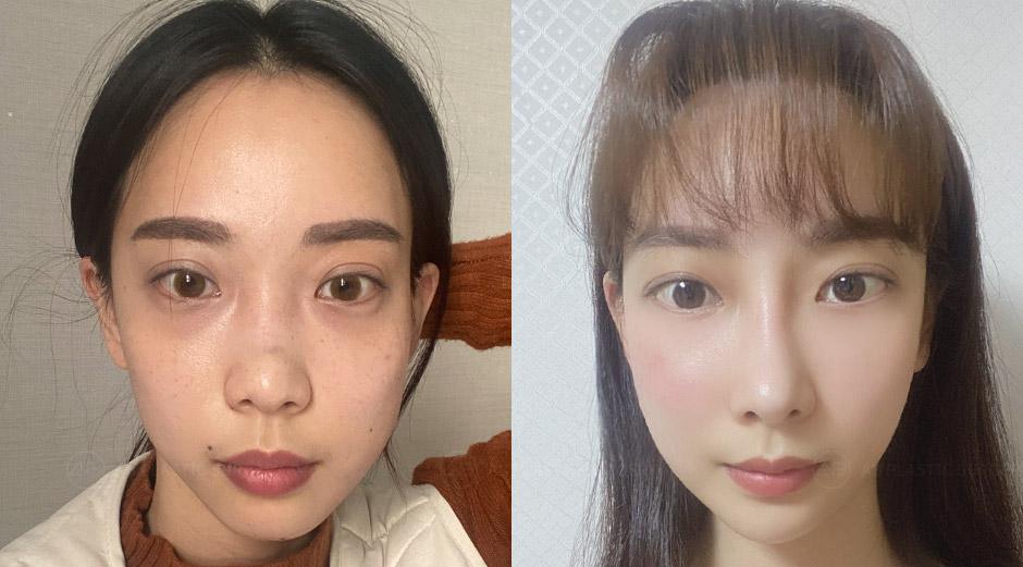 Eyelid surgery, nose job, fIncisional Ptosis Correction, Rhinoplasty (Hump Correction, Osteotomy), Facial Contouring (Cheekbone +Mandible Jaw+Genioplasty), Forehead Reduction, Fat Graftingacial contouring + forehead reduction
