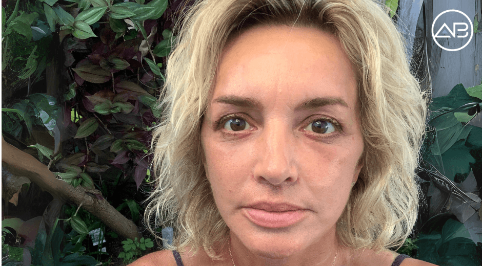 Rewind My Appearance Clock with Face & Neck Lifting & Anti Aging Surgery!