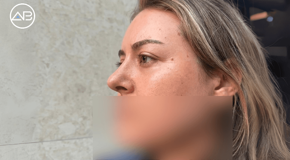 Natural Results and Exceptional Care: My Experience with AB Plastic Surgery