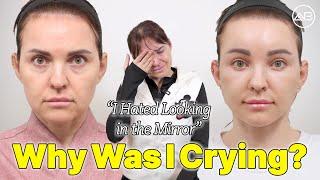  Why I Was Crying Before My Facelift in Korea | AB Plastic Surgery