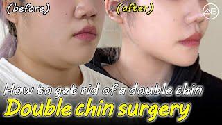 Submentoplasty That Changes Your Entire Face | AB Plastic Surgery