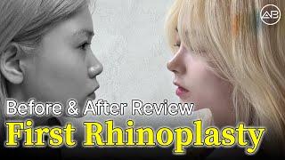 My First Rhinoplasty in Korea | AB Plastic Surgery