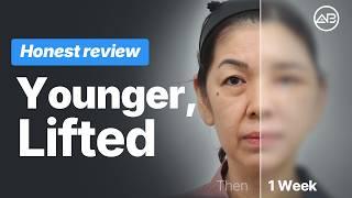 1 Week After Facelift in Korea | Real Patient Glow Up & Recovery Review 😍 | AB Plastic Surgery