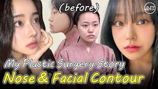 My Nose & Facial Contour Transformation in Korea | AB Plastic Surgery